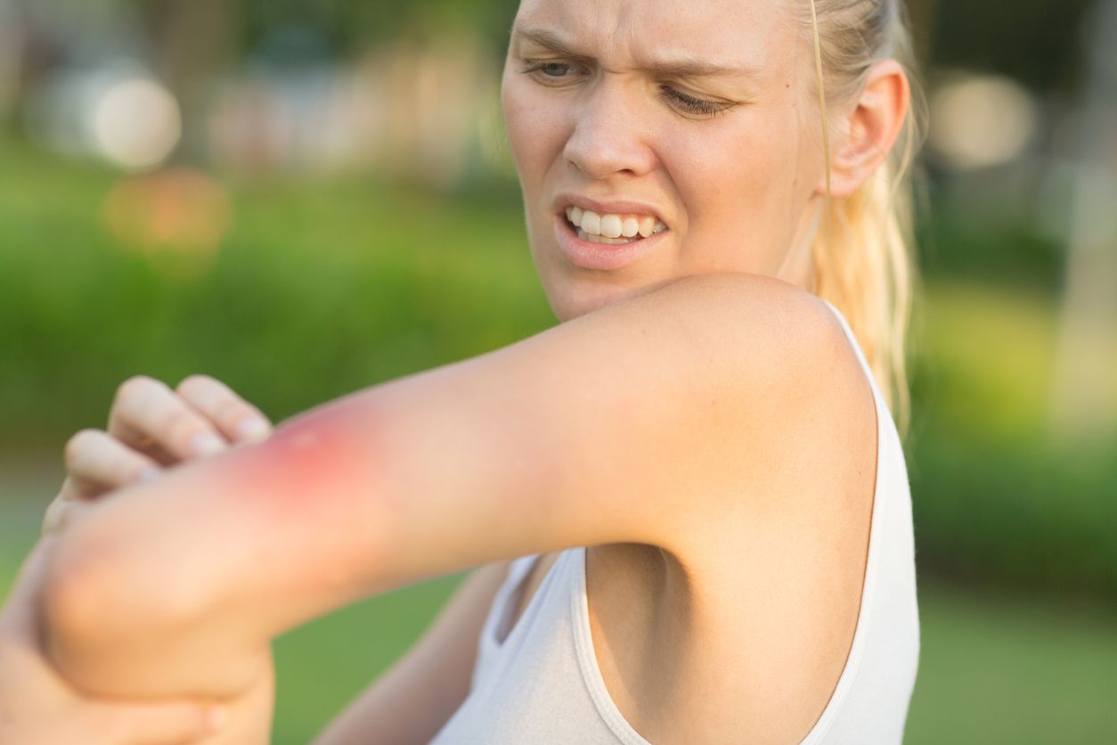 An annoyed young woman scratching her arm, itching from a mosquito bite.